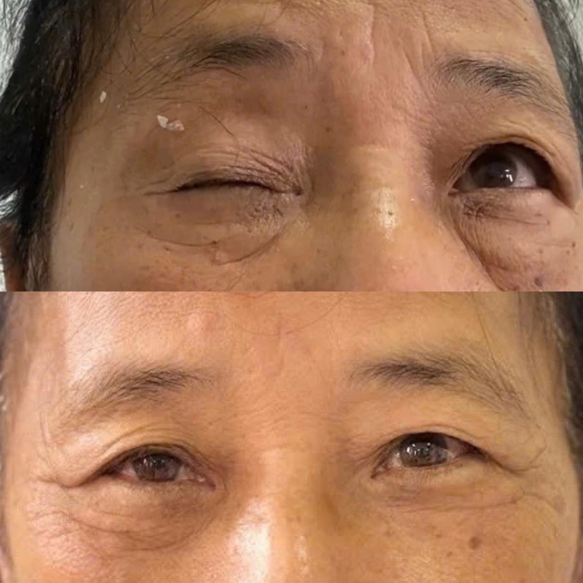 Điều trị thành công bệnh sụp mi tại Bệnh viện Y Dược cổ truyền và Phục hồi chức năng tỉnh Phú Thọ